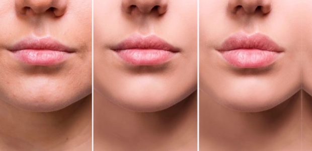 lip reduction